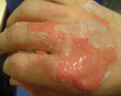 tecnicas-de-reconstruccion-de-la-piel-tras-una-quemadura imagen de artículo