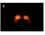 enfermedad-de-parkinson-y-trastornos-del-movimiento imagen de artículo