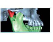 como-tratar-los-problemas-en-la-mandibula imagen de artículo