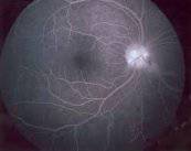 degeneracion-macular-asociada-a-edad imagen de artículo