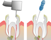 La Endodoncia elimina de manera definitiva el dolor agudo