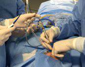 tratar-patologia-de-las-glandulas-salivares-sin-cirugia imagen de artículo