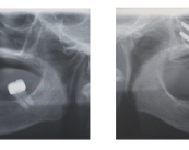 implantes-cigomaticos-solucion-a-la-ausencia-de-hueso-maxilar imagen de artículo