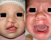 labio-leporino-un-defecto-congenito-muy-frecuente imagen de artículo