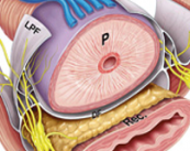 prostatectomia-radical-laparoscopica-tratamiento-para-el-cancer-de-prostata imagen de artículo