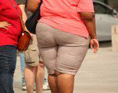 La principal causa de obesidad mórbida es el sedentarismo