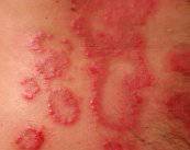 enfrentatae-a-la-psoriasis-causas-y-tratamiento imagen de artículo
