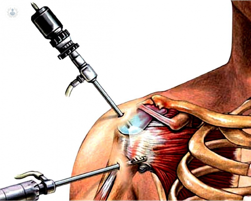artroscopia-de-hombro-en-que-consiste imagen de artículo