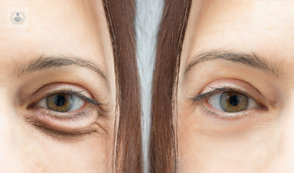 blefaroplastia-como-quitar-las-ojeras imagen de artículo