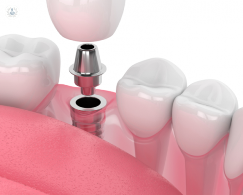 The advantages of dental implants immediately loaded