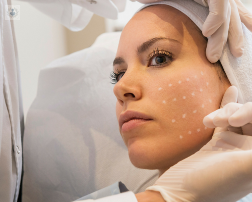 Mesoterapia facial: tratamiento preventivo y de reducción de arrugas faciales