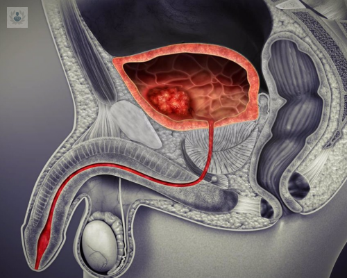 en-espana-se-diagnostican-cada-ano-12-000-nuevos-casos-de-cancer-de-vejiga imagen de artículo