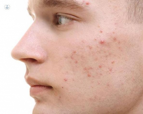 el-acne-no-esta-causado-por-la-ingesta-de-ciertos-alimentos imagen de artículo
