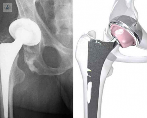 complicaciones-tras-una-cirugia-de-protesis-de-cadera imagen de artículo