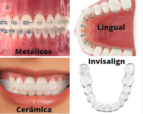 Diferencias entre ortodoncia lingual, tradicional e invisible