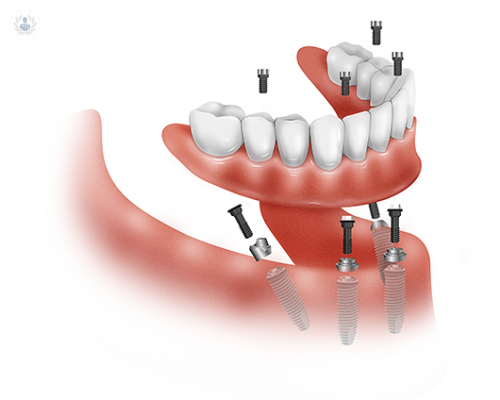 recupera-tus-dientes-perdidos-con-la-tecnica-all-on-four imagen de artículo