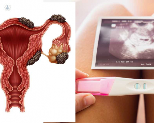 ¿Es posible quedarse embarazada si se padece endometriosis severa?