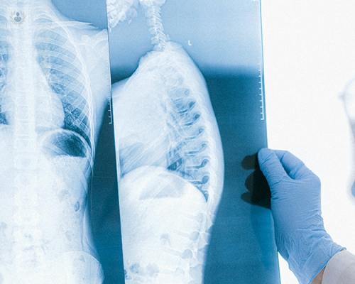 tumores-toracicos-tipos-y-tratamiento imagen de artículo