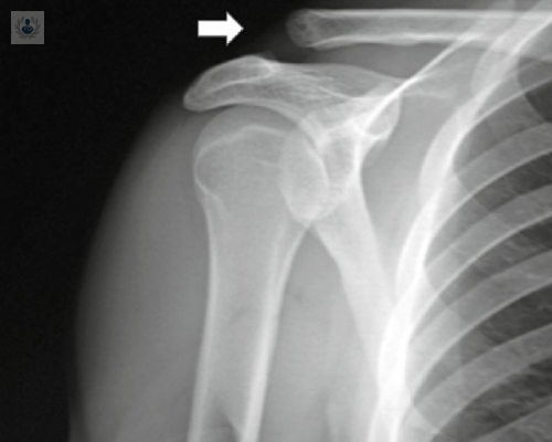 artroscopia-de-hombro-en-el-sindrome-de-atrapamiento imagen de artículo