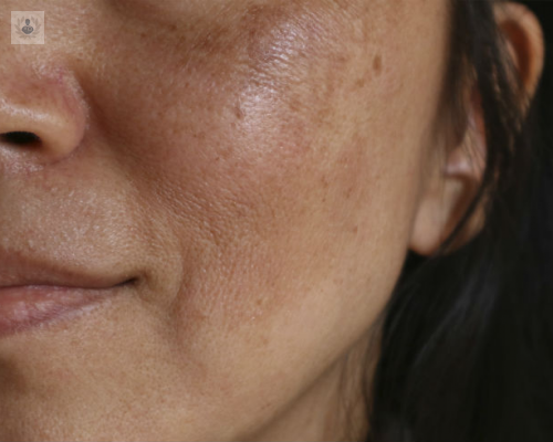 causas-y-tratamientos-del-melasma-manchas-faciales imagen de artículo
