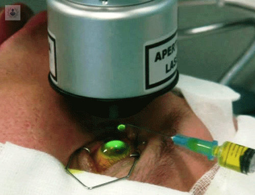 cross-linking-corneal-como-alternativa-al-trasplante-de-cornea imagen de artículo