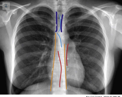 como-se-diagnostica-las-enfermedades-del-mediastino imagen de artículo