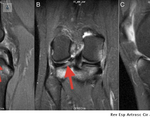 que-es-la-sutura-de-rotura-de-menisco imagen de artículo