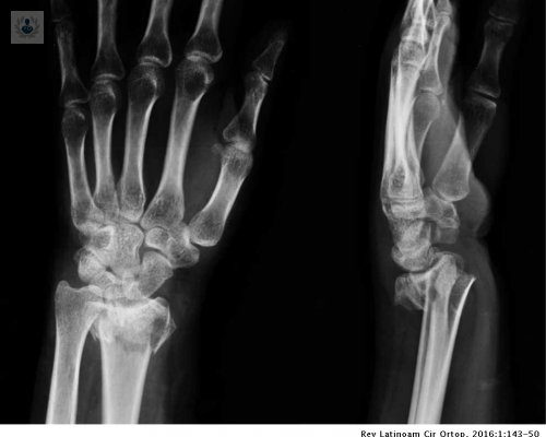 estudio-de-la-fractura-de-radio-distal imagen de artículo