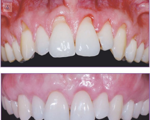 Nueva técnica de cirugía periodontal: menos complicaciones y más resultados