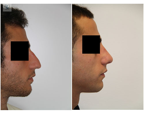 Rinoseptoplastia o septorrinoplastia: la operación de nariz