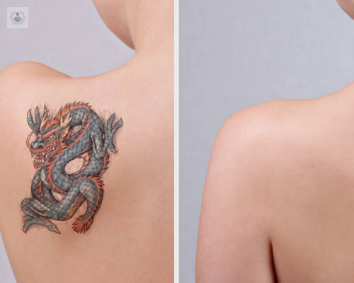 picoway-la-solucion-para-eliminar-tatuajes imagen de artículo