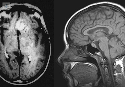 El Astrocitoma y el Glioma son un tipo de tumor cerebral