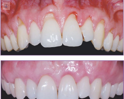 Tratamiento y resultados de la cirugía periodontal