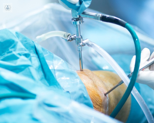 artroscopia-de-rodilla-una-cirugia-poco-agresiva-con-grandes-logros imagen de artículo