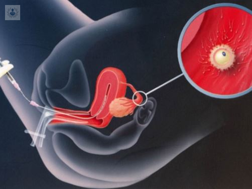 exito-de-la-inseminacion-artificial imagen de artículo