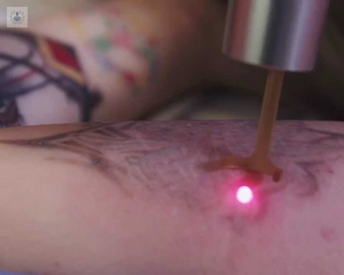 quitar-tatuajes-con-laser-picoway imagen de artículo