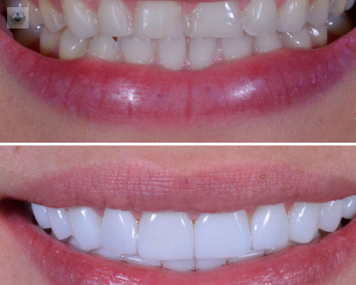 beneficios-de-las-carillas-dentales imagen de artículo