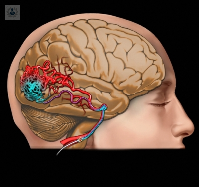 ultimos-avances-en-el-tratamiento-endovascular-a-traves-de-microcateteres-de-las-malformaciones-arteriovenosas-cerebrales-mav imagen de artículo