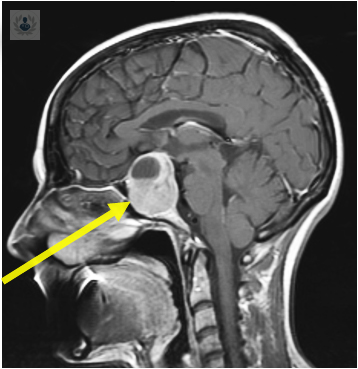 el-tumor-hipofisiario-que-es-y-como-se-detecta imagen de artículo