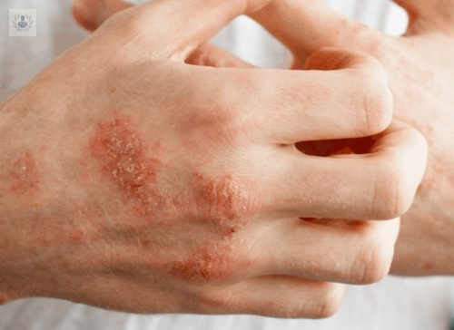 Dermatitis de contacto y alérgica