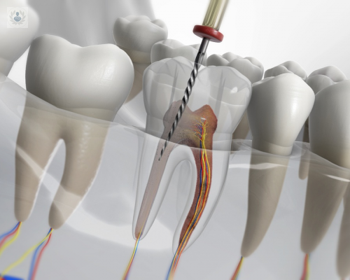 ¿De qué técnicas dispone la endodoncia?