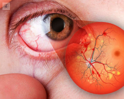 cuales-son-las-principales-enfermedades-de-la-retina imagen de artículo