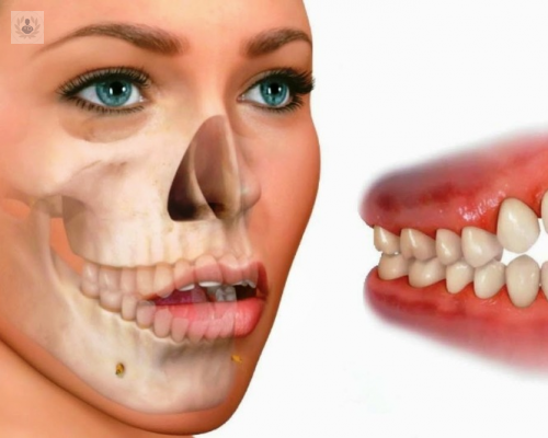 ¿Qué es la Maloclusión Dental?