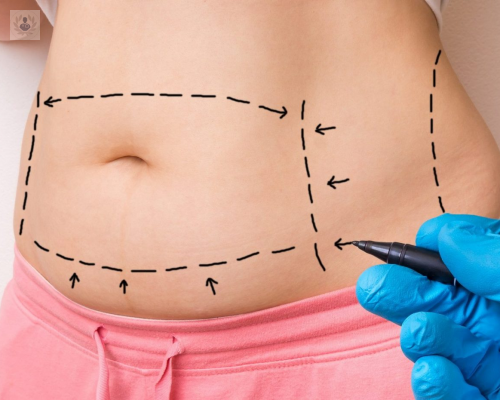 Abdominoplastia: cómo eliminar la grasa abdominal