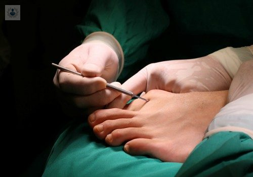 ¿Qué es la Cirugía Percutánea del Pie?