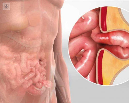 hernia-inguinal-sintomas-y-tratamiento imagen de artículo