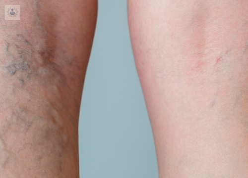eliminar-las-varices imagen de artículo