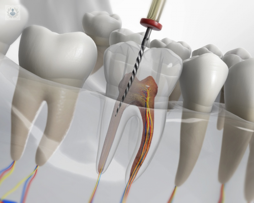 Preguntas frecuentes sobre Endodoncia