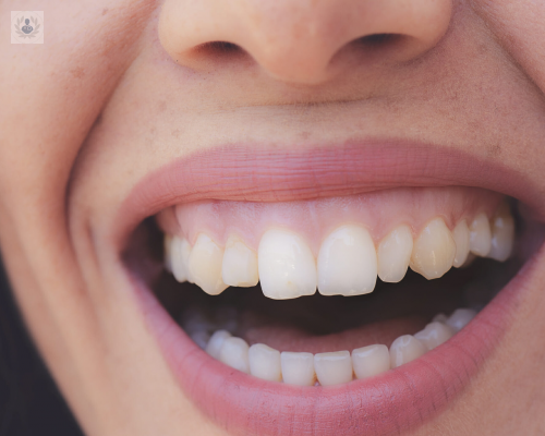 Gingivectomía: solución para la sonrisa gingival