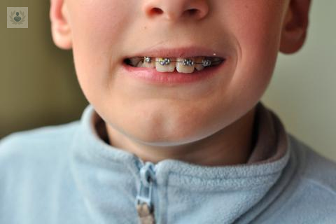 ortodoncia-en-ninos-cuando-y-por-que-colocarla imagen de artículo